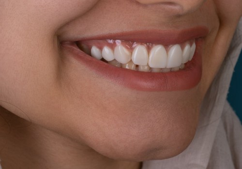 When is it Safe to Brighten Your Teeth?